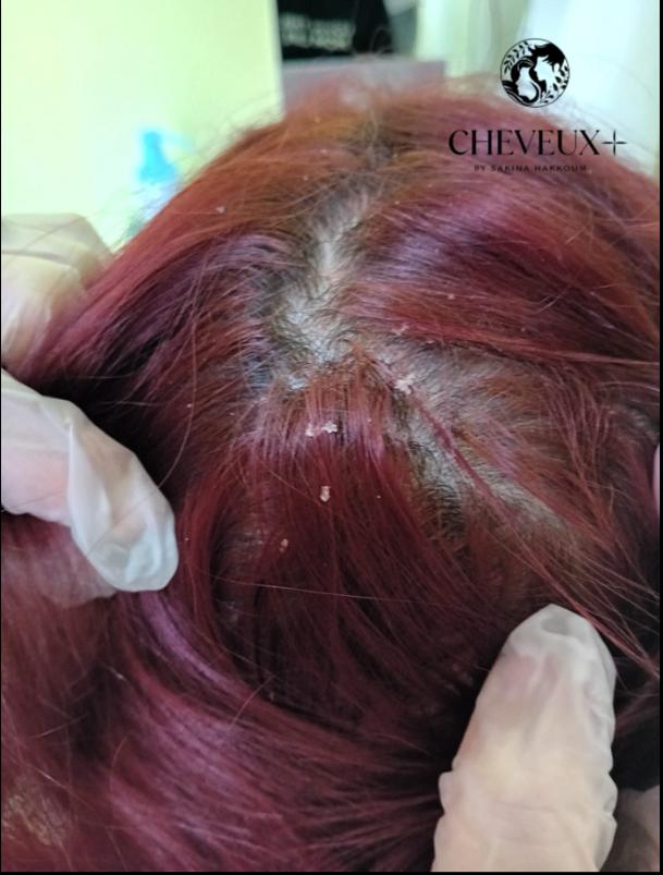 Cheveux plus avant/après trichologue Boulogne Billancourt